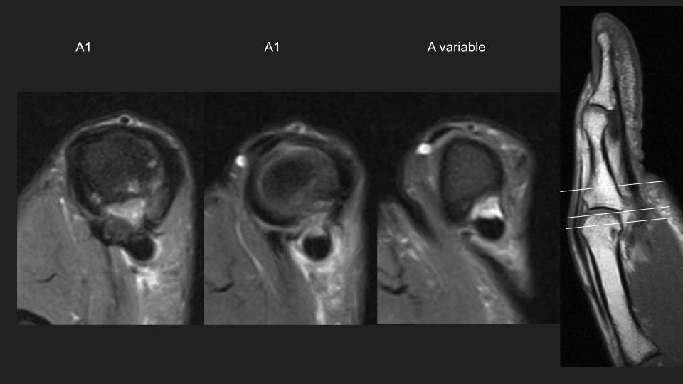 Figure 3 for case annular pulley of finger ( RID2435 )